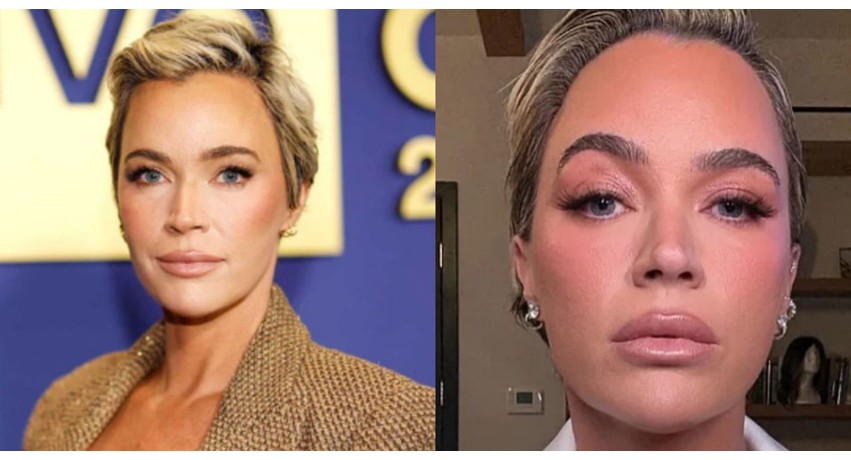 Në mes të betejës me kancerin, Teddi Mellencamp i nënshtrohet një ndërhyrjeje estetike
