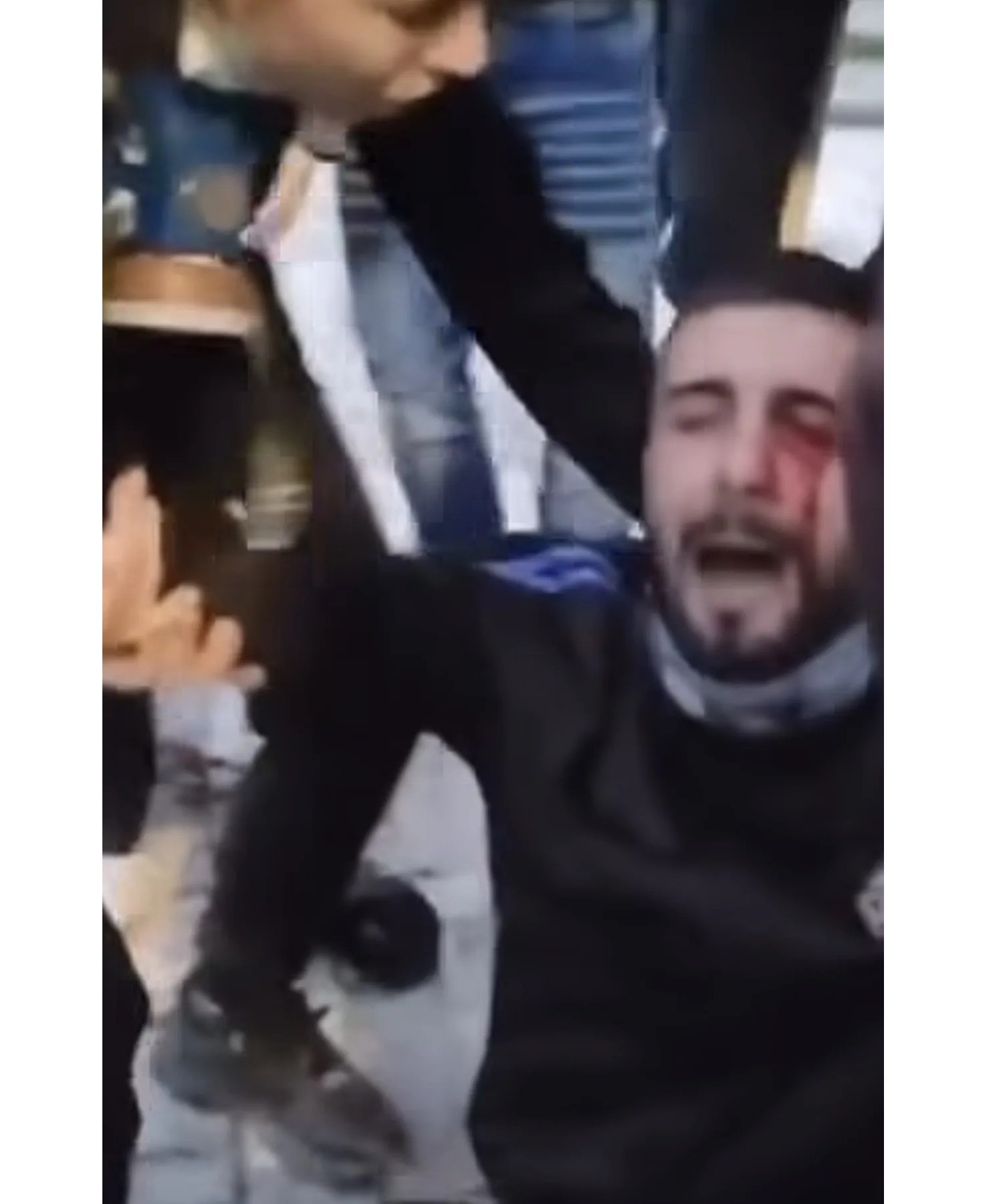 Trazirat në Tiranë: Protestuesi plagoset rëndë në sy nga plumbat e gomës të Policisë