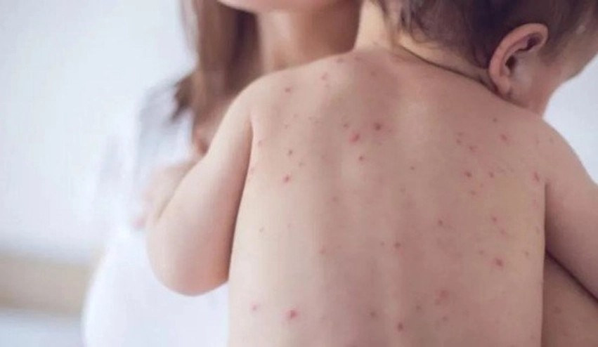 Situata e fruthit në vend: Mbi 200 raste të konfirmuara, IKShPK bën thirrje urgjente për vaksinim